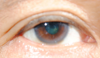 unclear eye photo example